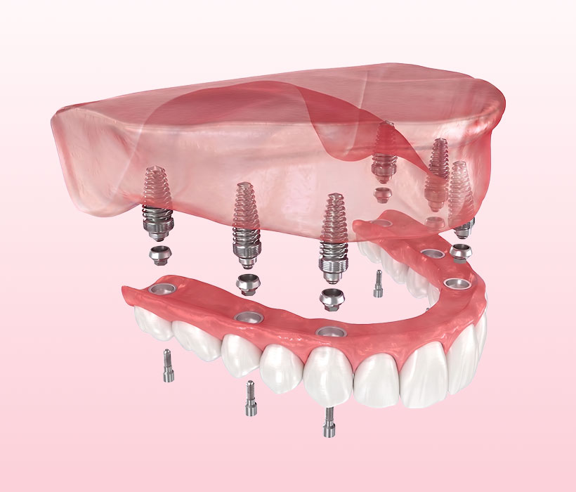 All-on-4/6® Implantate