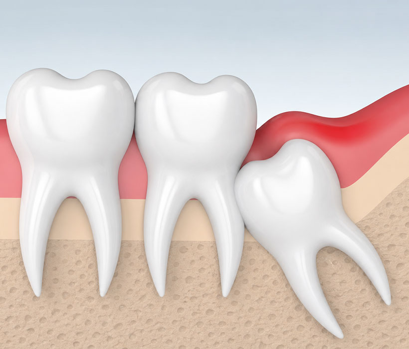 Extraction des dents de sagesse