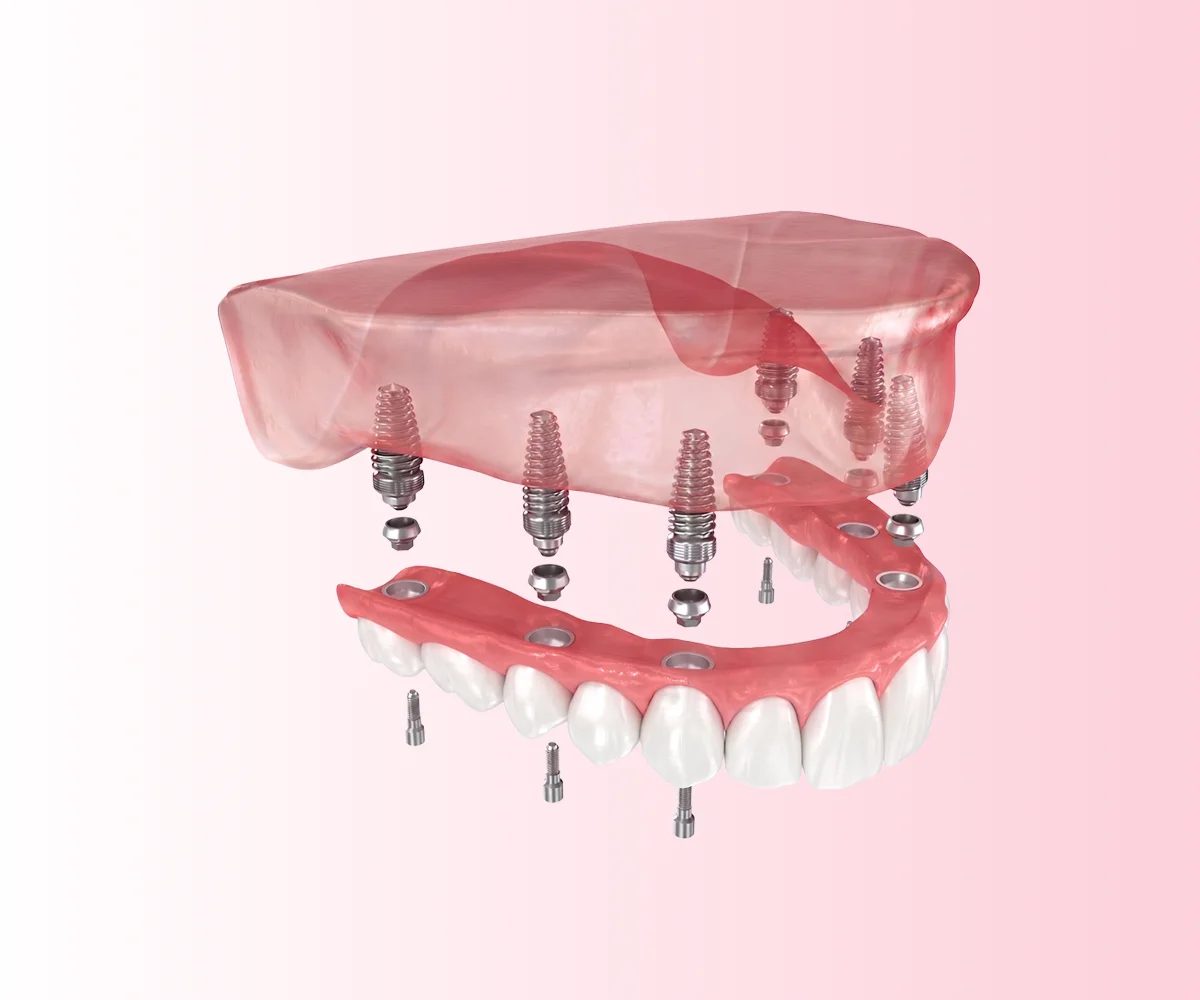 All-on-4 and All-on-6 dental implant treatments in Istanbul