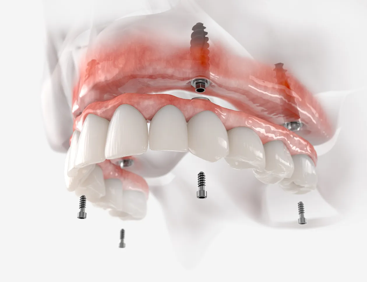 Positionnement de quatre implants dans la mâchoire pour un traitement All-on-4